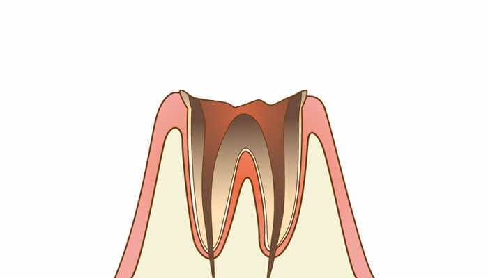 C4：歯質が失われた虫歯
